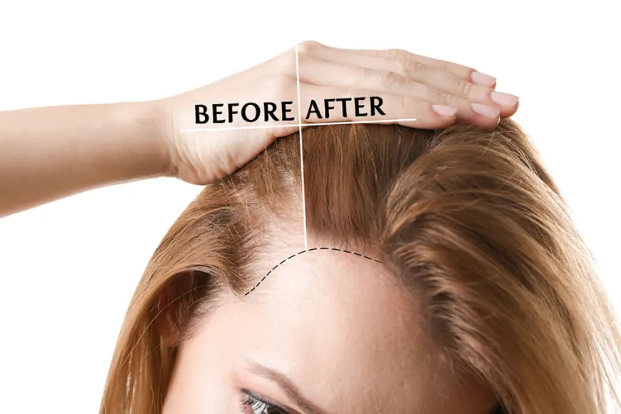 What is Female Hair Transplant Cost in Delhi: Factors & Price Guide