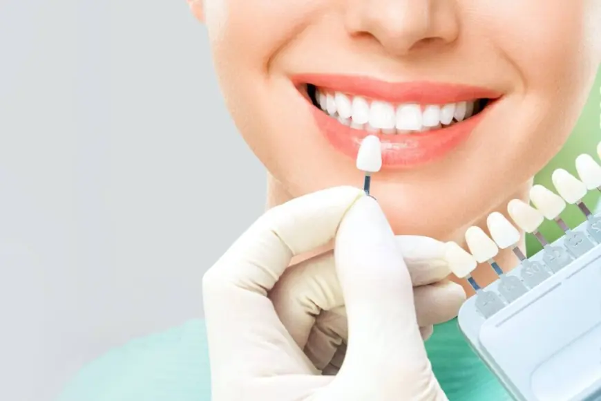 Are Veneers in Dubai Worth the Investment? Here’s What You Need to Know