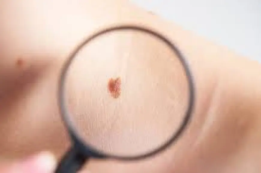 How to Identify Early Signs of Skin Cancer Spots