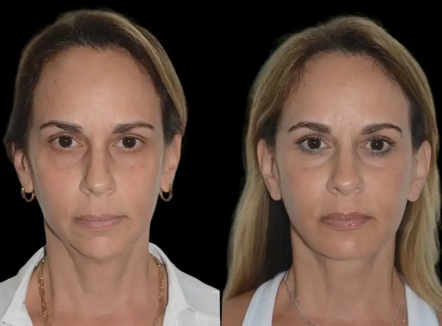Enhance Your Chin with the Best Doctors in Dubai