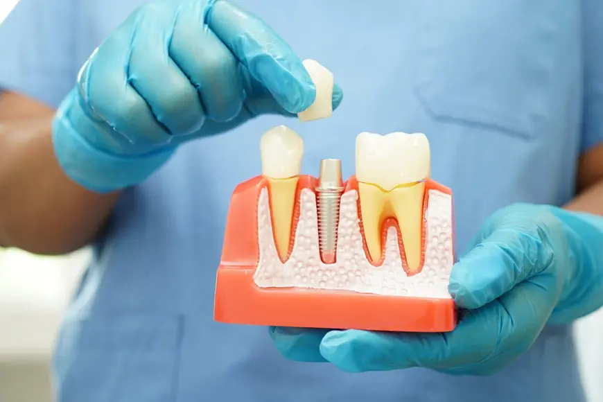 Can’t Chew Like You Used To? Implants May Be the Fix