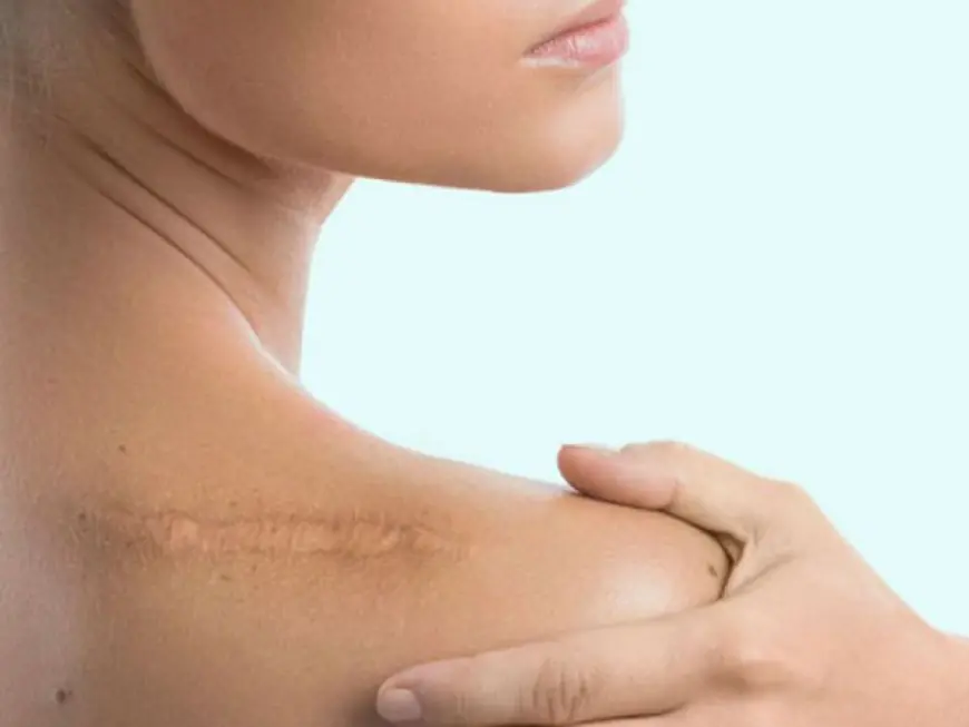 How to Choose the Right Clinic for Scar Removal in Dubai