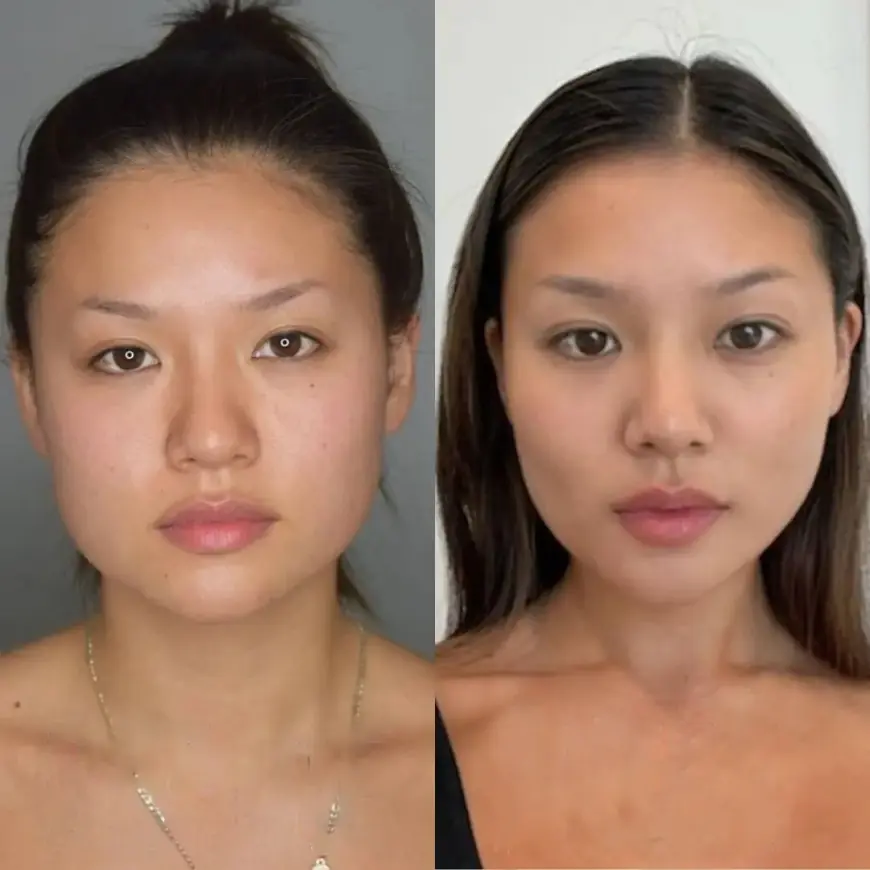 The Latest Innovations by the Best Buccal Fat Removal Surgeon in Dubai