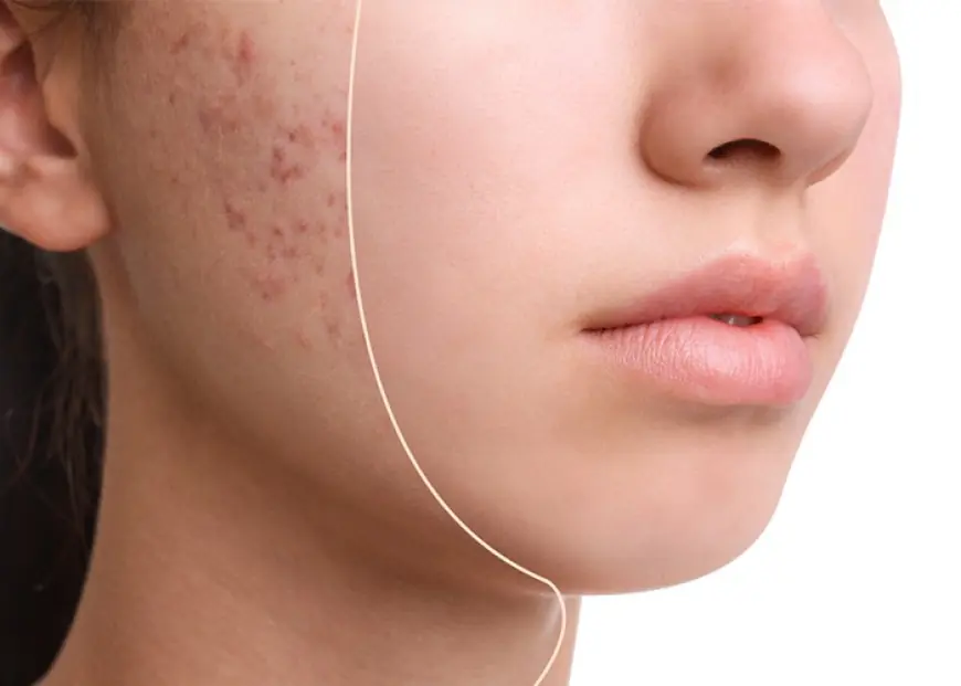 Say Goodbye to Acne Scars: Best Acne Scar Treatment