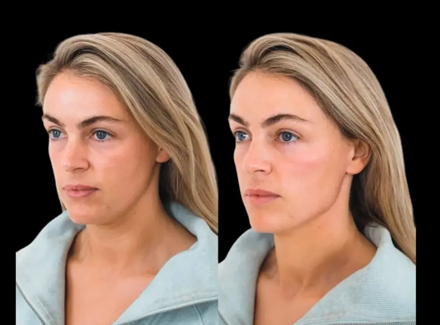 Best Aesthetic Clinic in Dubai: Your Destination for Stunning Cheek Fillers
