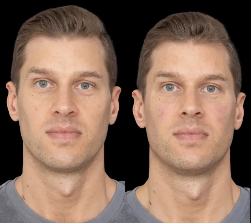 Under Eye Fillers at the Best Aesthetic Clinic in Dubai: A Smart Choice