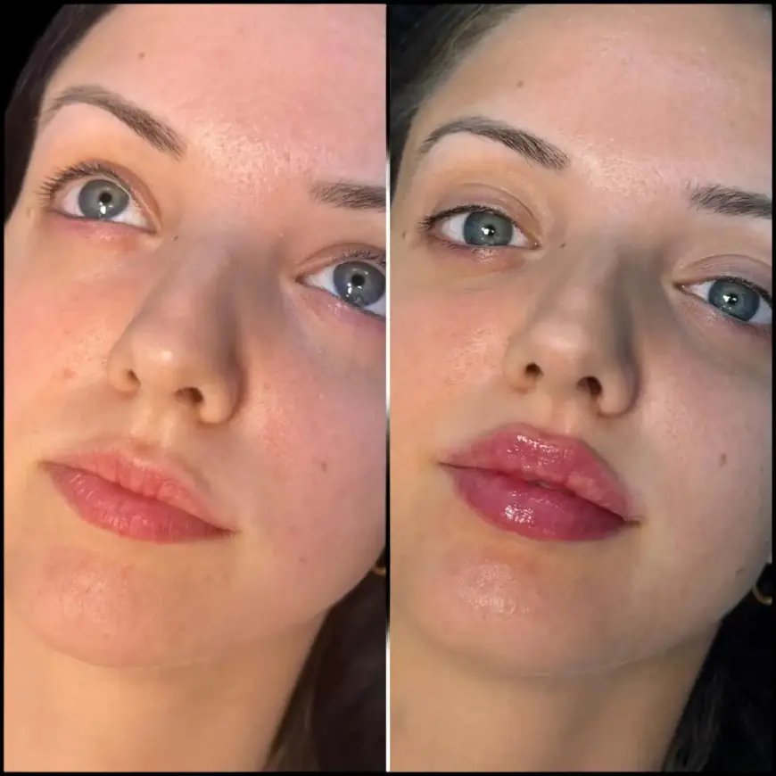 The Best Doctors in Dubai Offer Customized Fillers for Every Client