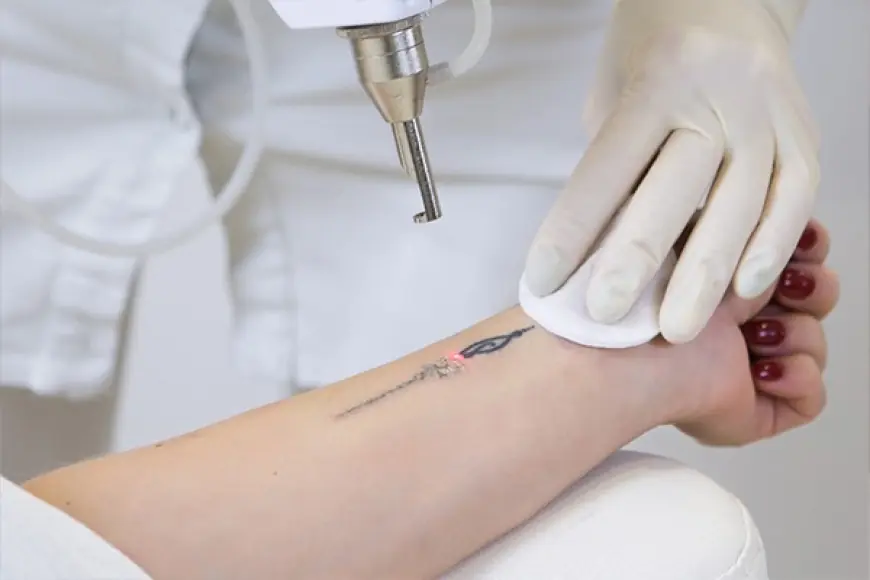 Laser Tattoo Removal in Delhi – Safe & Effective