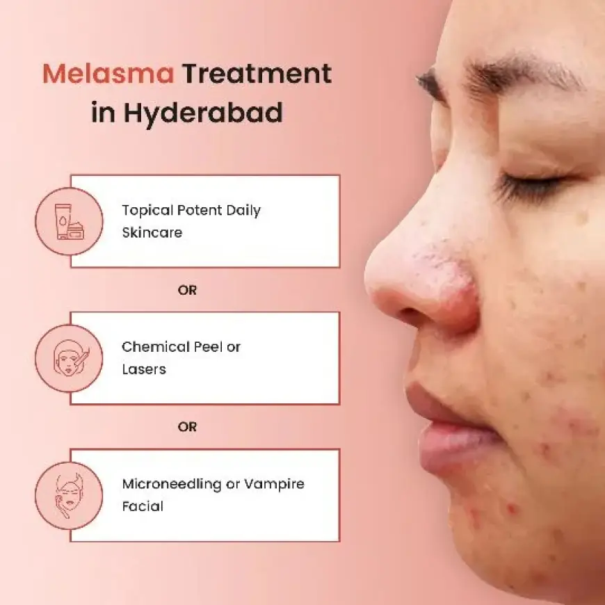 Melasma Treatment: Regain Clear, Even-Toned Skin