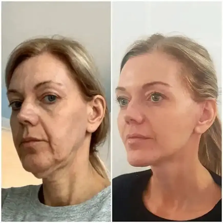 Activate Skin Magic with Profhilo from the Best Aesthetic Clinics in dubai
