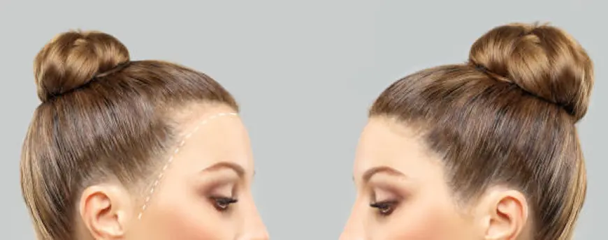 تجارب زراعة الشعر في الرياض.. اكتشف الحل المثالي لك