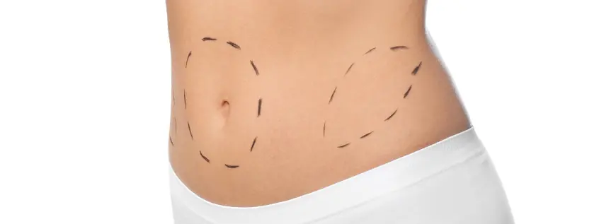When is the Best Time to Get a Tummy Tuck Surgery?