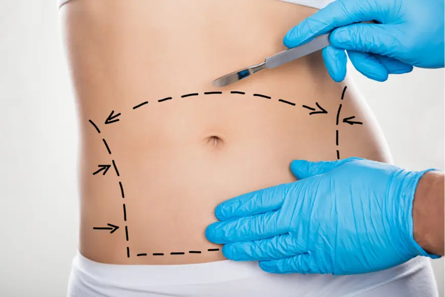 What Does a Tummy Tuck Surgery Actually Involve?