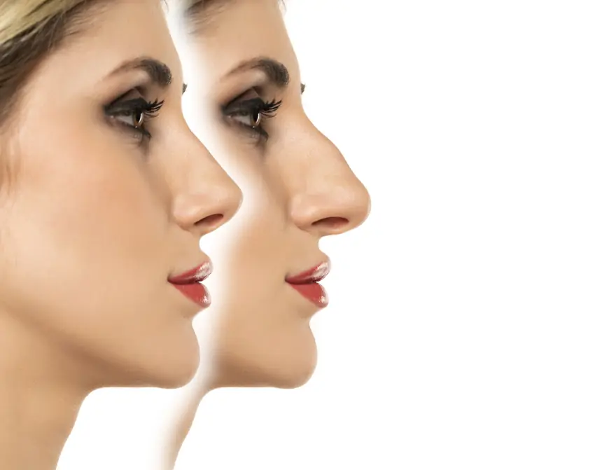 Cost of Preservation Rhinoplasty in Dubai: What You Need to Know