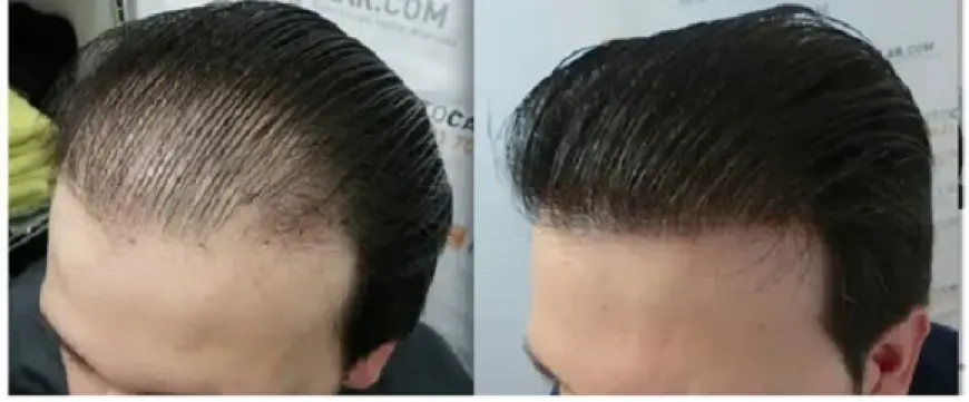 How Many Sessions of Plasma Injection Are Needed for Hair Growth in Dubai?