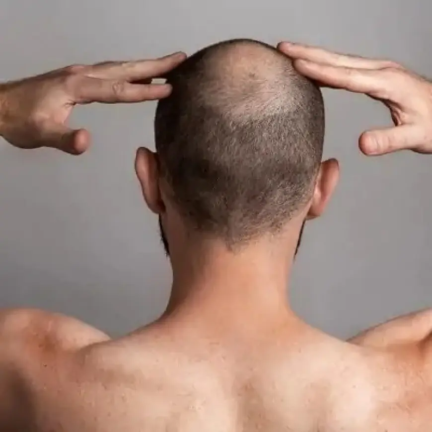 What to Expect One Year After Hair Transplant in Dubai: Realistic Outcomes