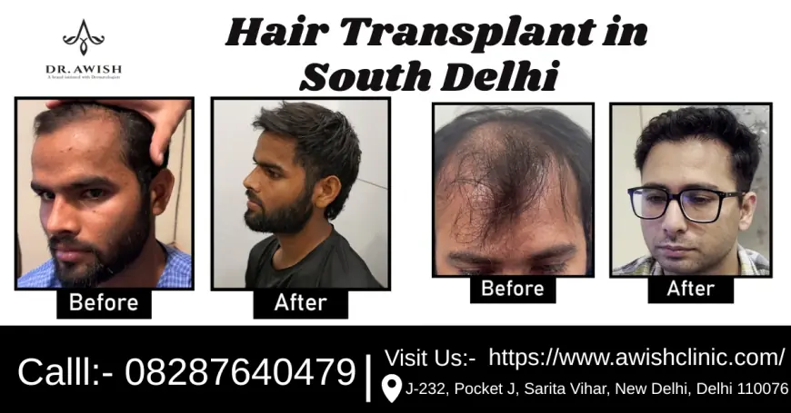 Hair Transplant in South Delhi Top Clinics, Cost & Real Results (2025 Guide)