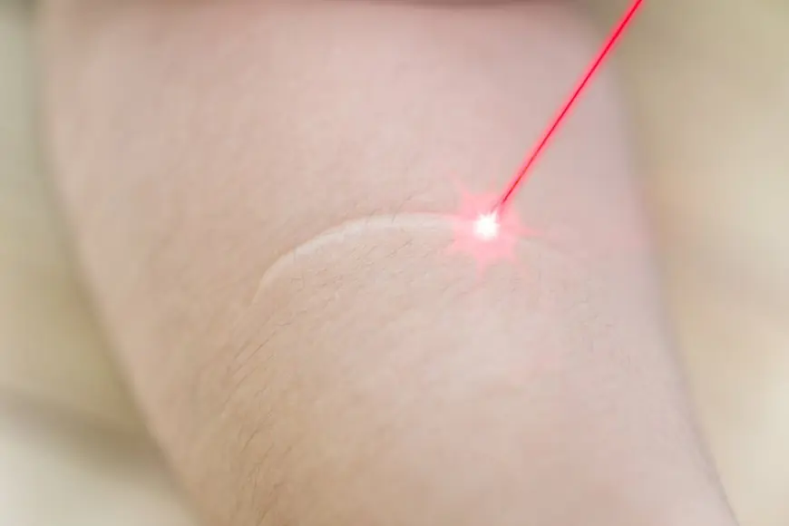 Why Laser Scar Removal Cost in Dubai Varies So Much