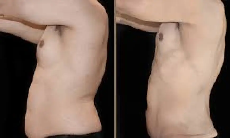 How to Maintain Results After Vaser 4D Liposuction?