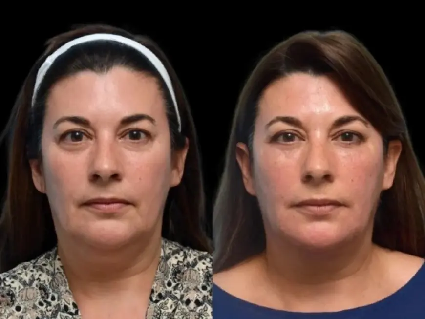 Why the Best Doctors in Dubai Are Trusted for Safe and Effective Dark Circles Treatment