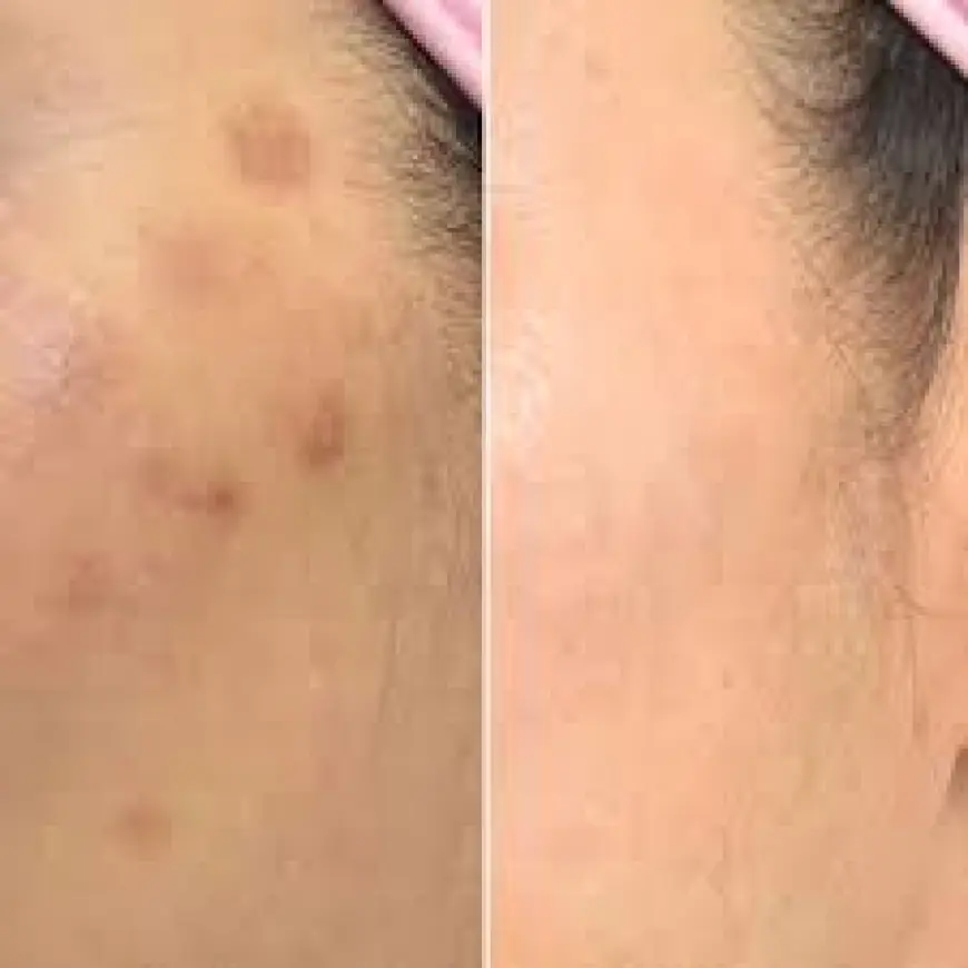 Pico Laser Treatment in Islamabad: The Smart Choice for Flawless Skin