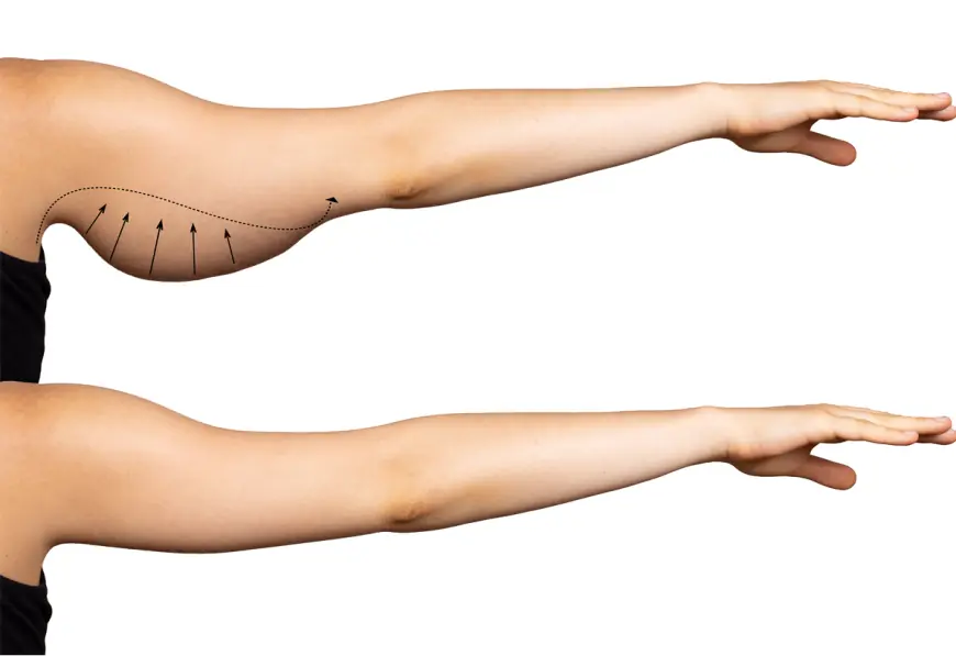 Before and After Results of Arm Contouring Surgery