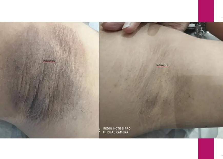 Dark Underarms Treatment: Causes, Solutions & What to Expect
