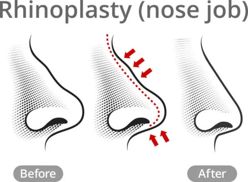 Before & After: My Rhinoplasty Transformation in Islamabad