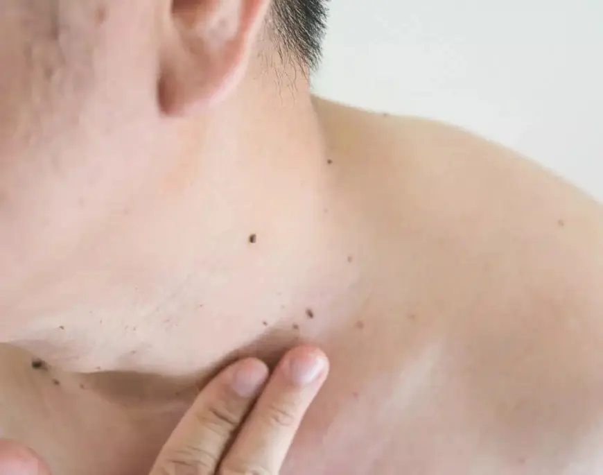 Top 5 Things to Know About Warts Removal Surgery