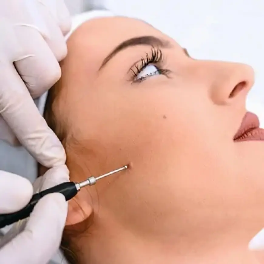 Birthmark Removal in Dubai for Kids: A Parent’s Guide