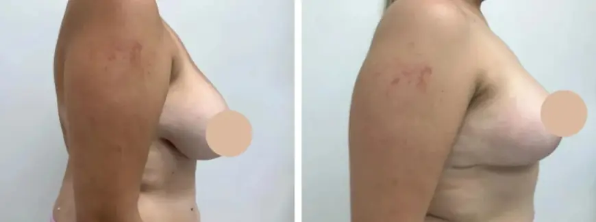 Patient Rights and Informed Consent for Breast Reduction in Dubai