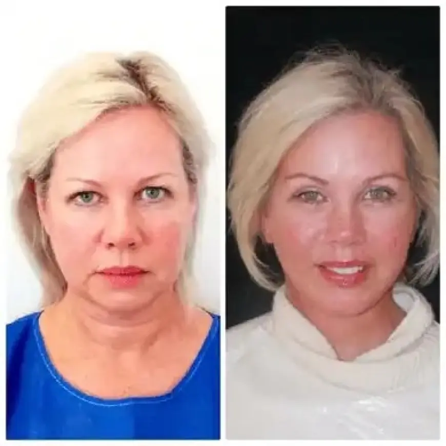 Reveal Refined Beauty through Profhilo Treatments in Dubai