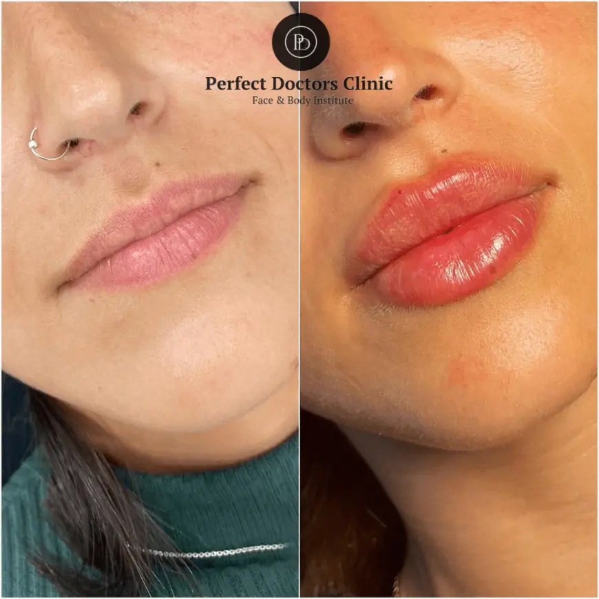 Juvederm for Acne Scars: What the Best Doctors in Dubai Recommend