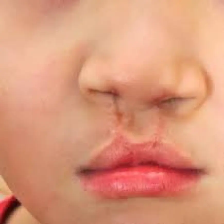 Restoring Confidence with Cleft Lip and Palate Solutions in Islamabad