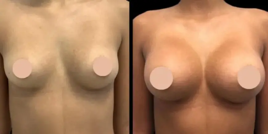 Innovative Techniques Used by the Best Breast Augmentation Surgeons in Dubai