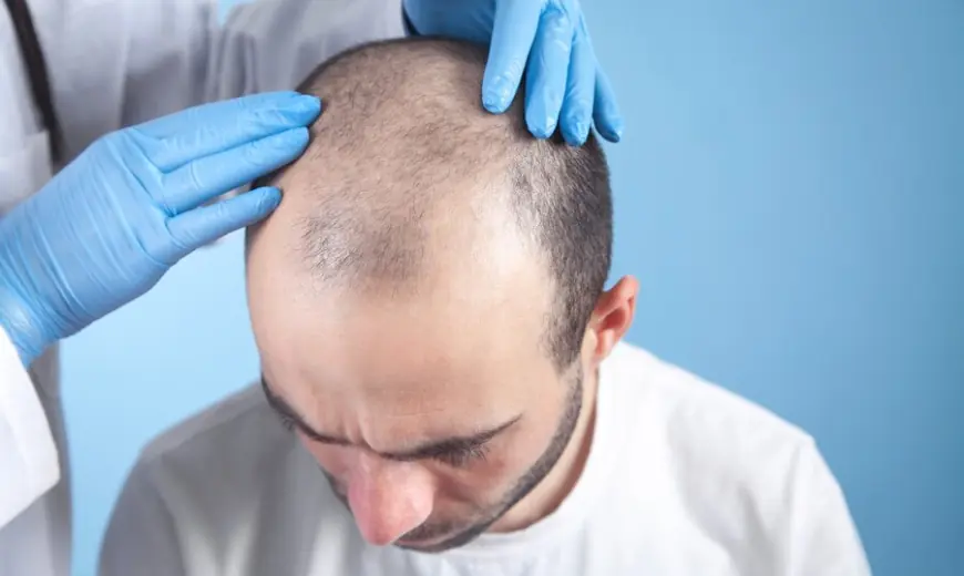 Want Hair LTD Sets the Standard for FUE Hair Transplants at Leading UK Hair Transplant Clinic
