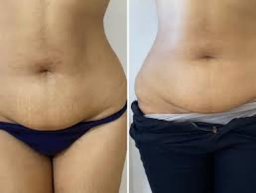 What It Feels Like to Get Fat Melting Injections?