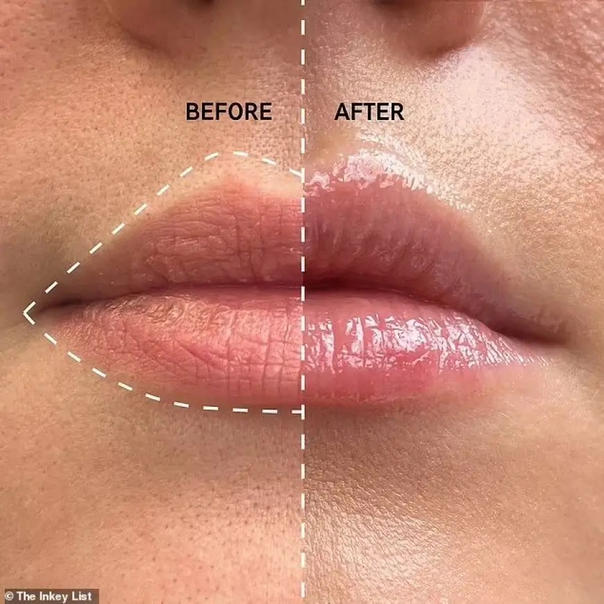 Natural-Looking Lip Enhancement with Fillers in Islamabad