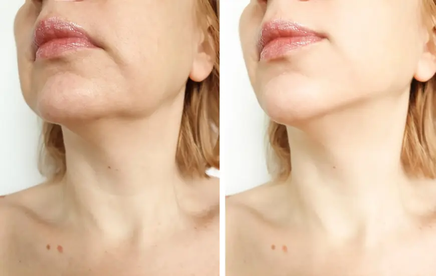 Will Laser Skin Tightening Work for Saggy Arms?