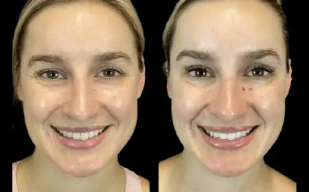 Trending Now: New Botox Techniques at the Best Aesthetic Clinics in dubai