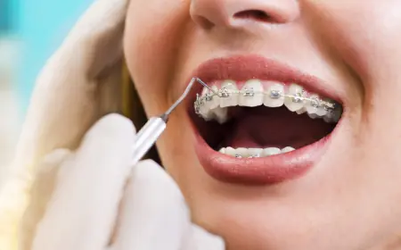 Braces and Dating: Navigating Relationships with Metal Braces