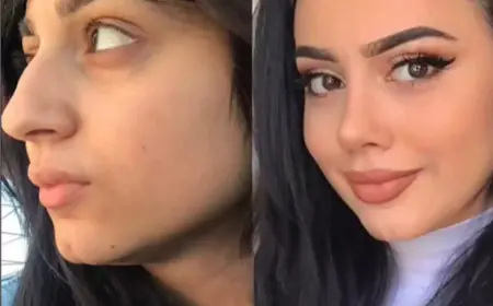 Everything You Need to Know About Rhinoplasty Dubai Procedures