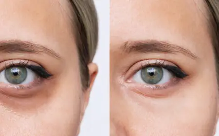 كيف يسبب فقر الدم ظهور الهالات السوداء؟