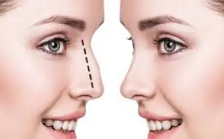 Rhinoplasty in Dubai: What to Expect Before, During, and After the Procedure