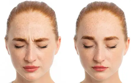 Botox Bekymringsrynke