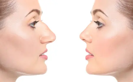 Glow from Every Angle with Rhinoplasty Price in Dubai