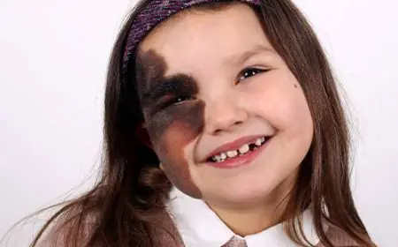 Birthmark Removal in Dubai for Facial Marks: Boost Your Confidence