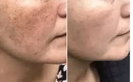 Melasma Treatment in Islamabad: Safe & Proven Solutions for Radiant Skin