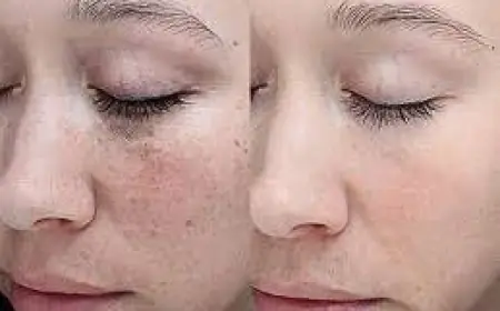 تقشير كيميائي للتصبغات: قبل وبعد بالصور