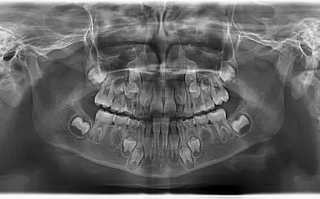 Panoramic Dental X-Ray Cost: Is It Worth It?